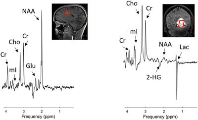 High-Grade Glioma Treatment Response Monitoring Biomarkers: A Position Statement on the Evidence Supporting the Use of Advanced MRI Techniques in the Clinic, and the Latest Bench-to-Bedside Developments. Part 2: Spectroscopy, Chemical Exchange Saturation, Multiparametric Imaging, and Radiomics